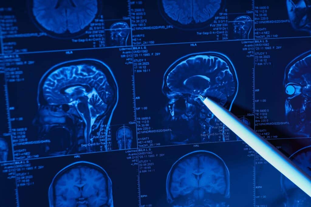 X-ray of a person's brain showing a traumatic brain injury